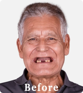 Before a 3 on 6 treatment